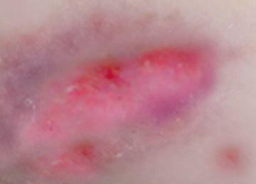 Pressure ulcers: Grade 1 Discolouration