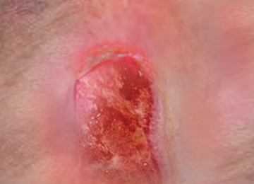 Pressure ulcers: Grade 2