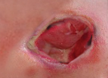 Pressure ulcers: Grade 3