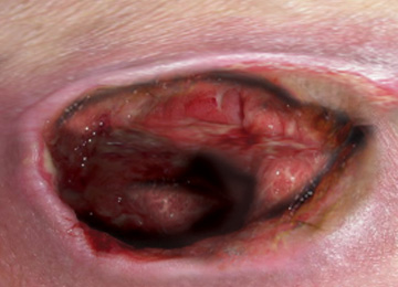 Pressure ulcers: Grade 4
